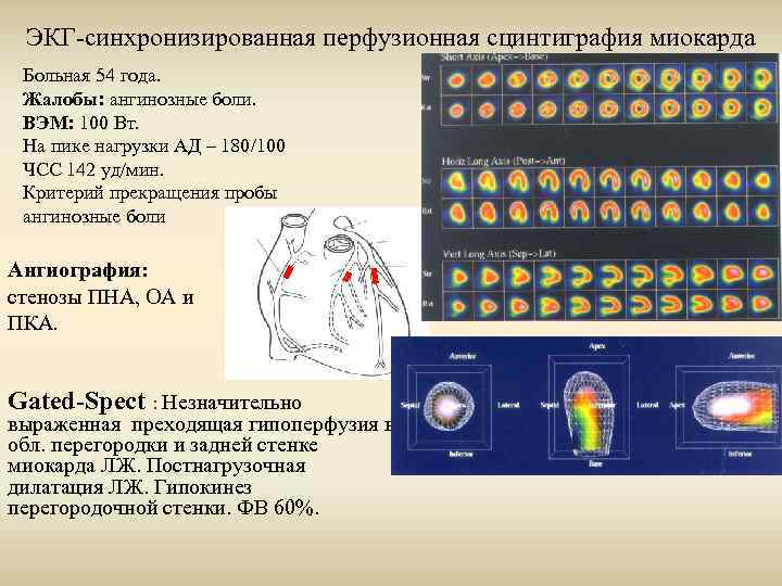 Презентация сцинтиграфия миокарда