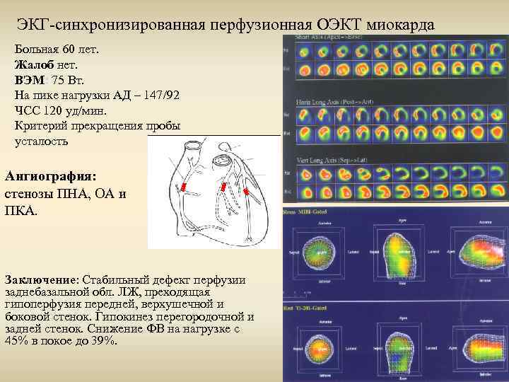 ЭКГ-синхронизированная перфузионная ОЭКТ миокарда Больная 60 лет. Жалоб нет. ВЭМ: 75 Вт. На пике