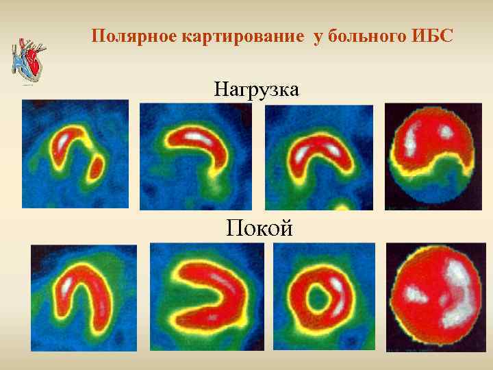 Полярное картирование у больного ИБС Нагрузка Покой 