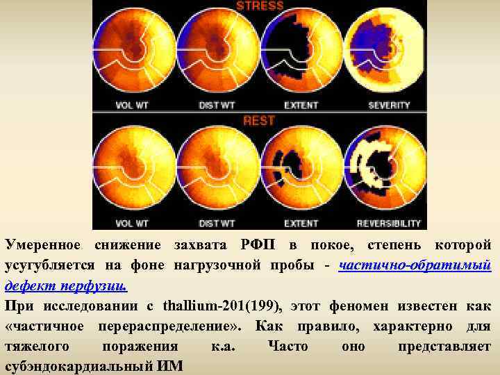 Умеренное снижение захвата РФП в покое, степень которой усугубляется на фоне нагрузочной пробы -