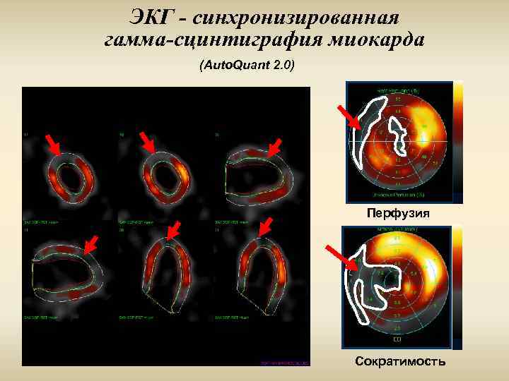 ЭКГ - синхронизированная гамма-сцинтиграфия миокарда (Auto. Quant 2. 0) Перфузия Сократимость 