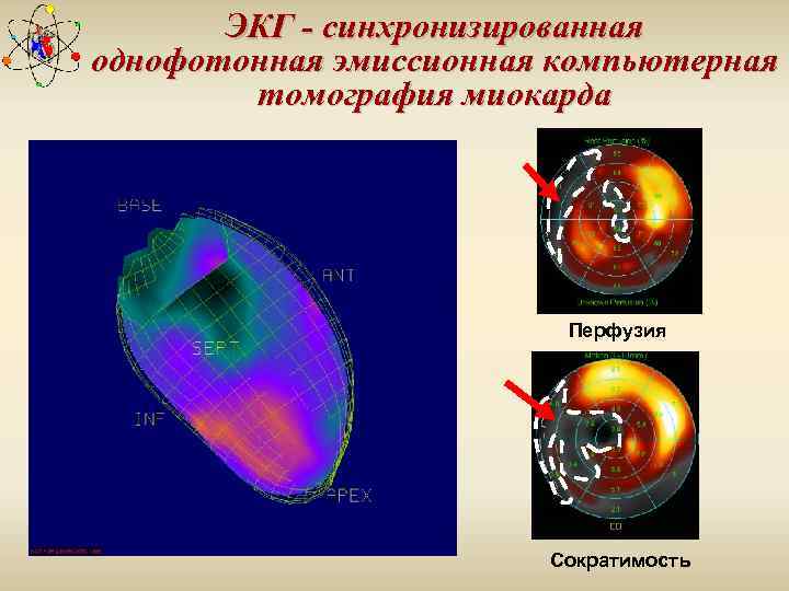 Что такое однофотонная эмиссионная компьютерная томография