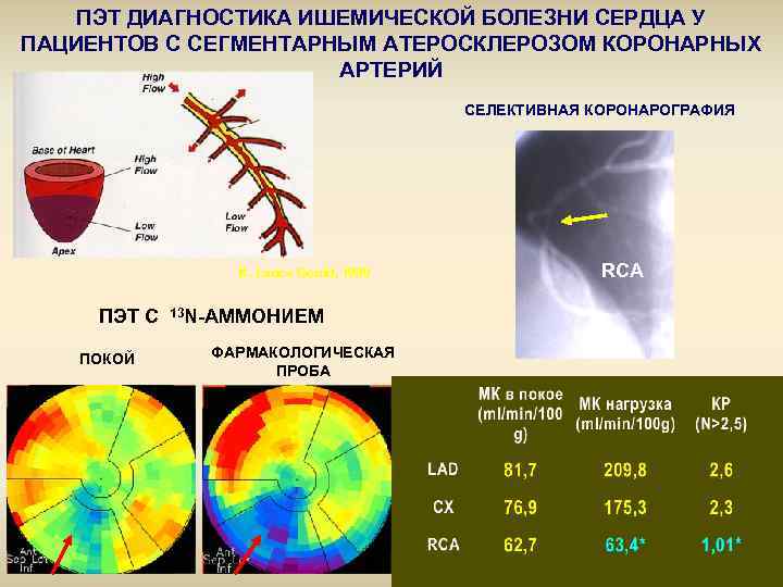 ПЭТ ДИАГНОСТИКА ИШЕМИЧЕСКОЙ БОЛЕЗНИ СЕРДЦА У ПАЦИЕНТОВ С СЕГМЕНТАРНЫМ АТЕРОСКЛЕРОЗОМ КОРОНАРНЫХ АРТЕРИЙ СЕЛЕКТИВНАЯ КОРОНАРОГРАФИЯ