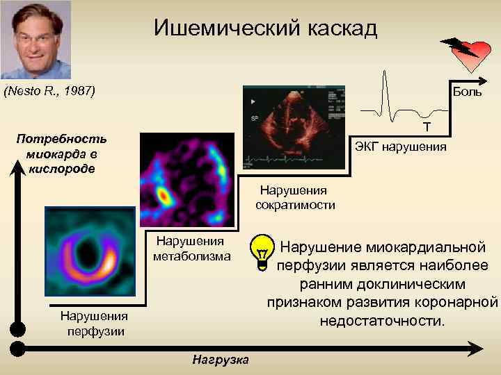 Ишемический каскад (Nesto R. , 1987) Боль T Потребность миокарда в кислороде ЭКГ нарушения