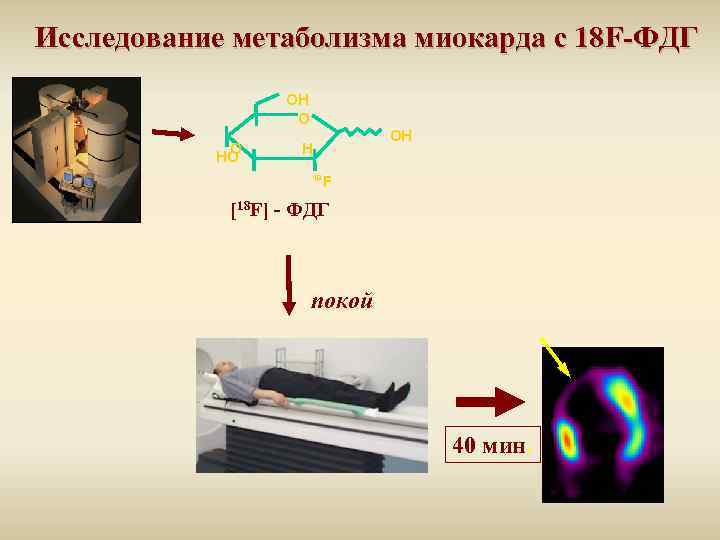 Исследование метаболизма миокарда с 18 F-ФДГ OH O O HO OH H 18 F