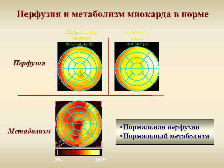 Перфузия и метаболизм миокарда в норме Перфузия при нагрузке Перфузия в покое Перфузия •