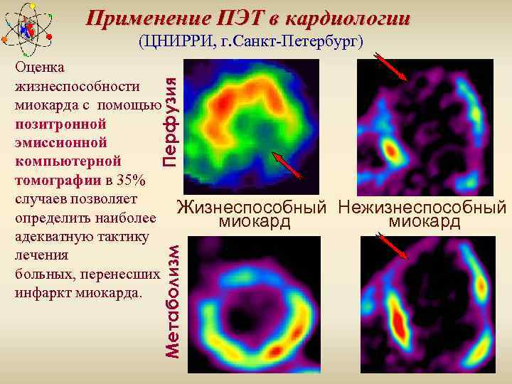 Применение ПЭТ в кардиологии (ЦНИРРИ, г. Санкт-Петербург) Метаболизм Перфузия Оценка жизнеспособности миокарда с помощью