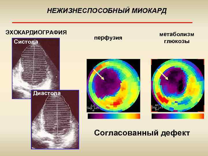 НЕЖИЗНЕСПОСОБНЫЙ МИОКАРД ЭХОКАРДИОГРАФИЯ Систола перфузия метаболизм глюкозы Диастола Согласованный дефект 