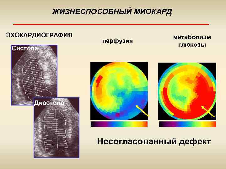 ЖИЗНЕСПОСОБНЫЙ МИОКАРД ЭХОКАРДИОГРАФИЯ Систола перфузия метаболизм глюкозы Диастола Несогласованный дефект 