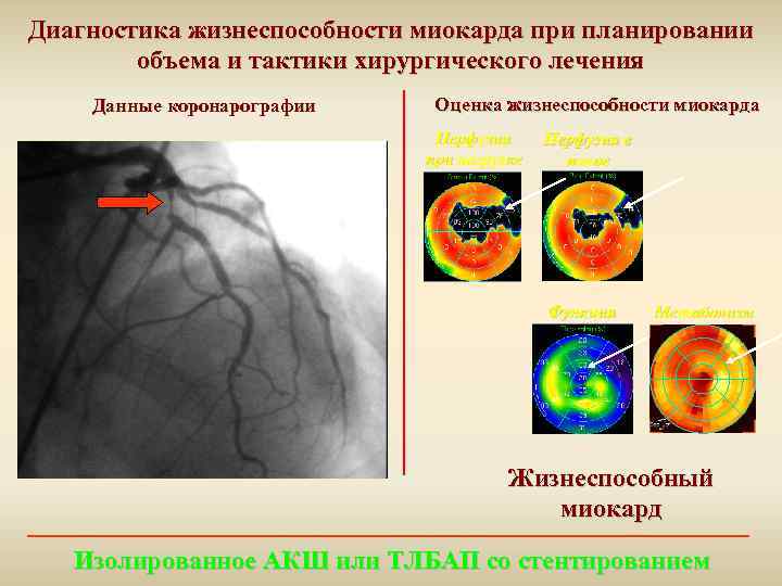 Диагностика жизнеспособности миокарда при планировании объема и тактики хирургического лечения Данные коронарографии Оценка жизнеспособности