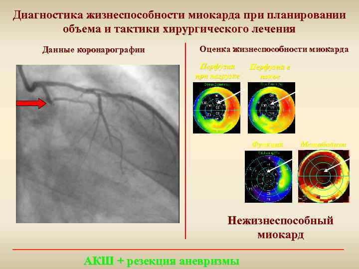 Диагностика жизнеспособности миокарда при планировании объема и тактики хирургического лечения Данные коронарографии Оценка жизнеспособности