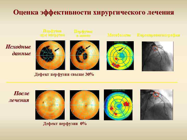 Оценка эффективности хирургического лечения Перфузия при нагрузке Перфузия в покое Метаболизм Metabolism (%) Исходные