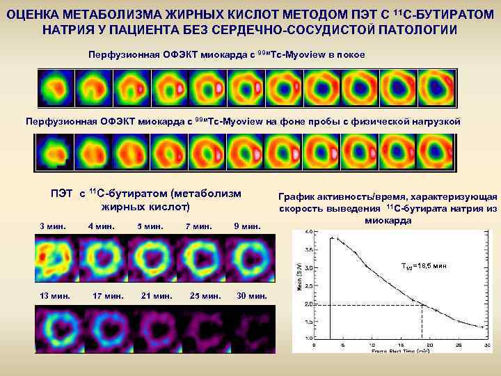 ОЦЕНКА МЕТАБОЛИЗМА ЖИРНЫХ КИСЛОТ МЕТОДОМ ПЭТ С 11 С-БУТИРАТОМ НАТРИЯ У ПАЦИЕНТА БЕЗ СЕРДЕЧНО-СОСУДИСТОЙ