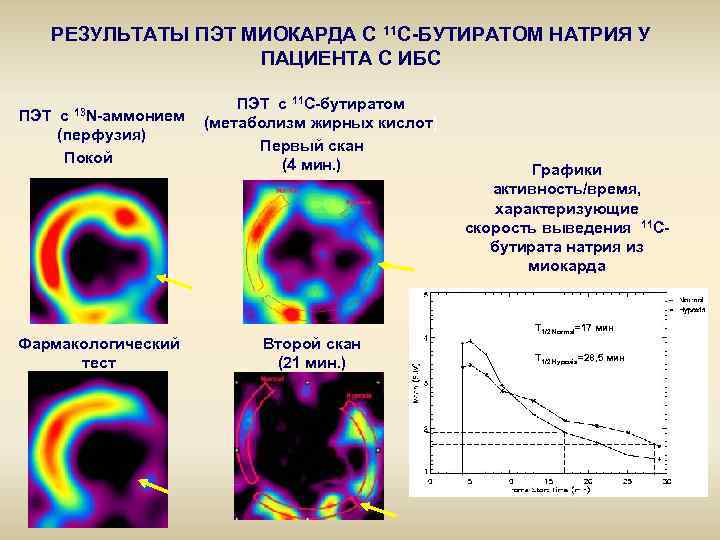 РЕЗУЛЬТАТЫ ПЭТ МИОКАРДА С 11 С-БУТИРАТОМ НАТРИЯ У ПАЦИЕНТА С ИБС 13 N-аммонием ПЭТ