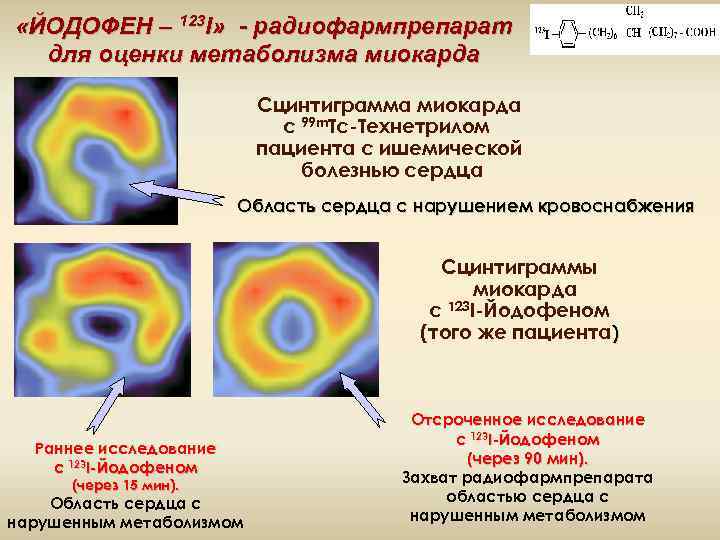  «ЙОДОФЕН – 123 I» - радиофармпрепарат для оценки метаболизма миокарда Сцинтиграмма миокарда с