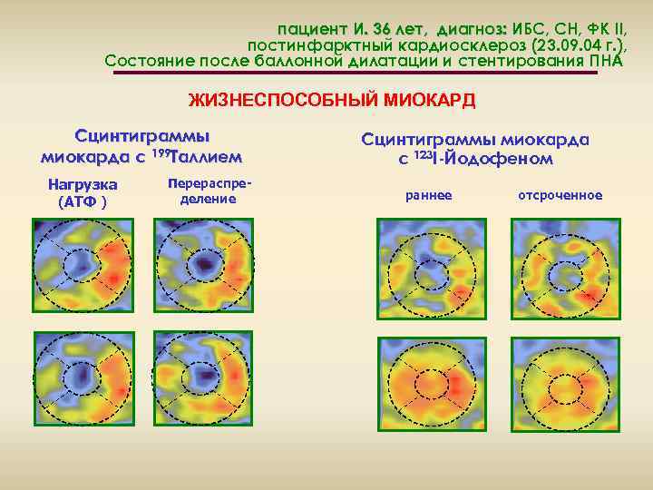 пациент И. 36 лет, диагноз: ИБС, СН, ФК II, постинфарктный кардиосклероз (23. 09. 04