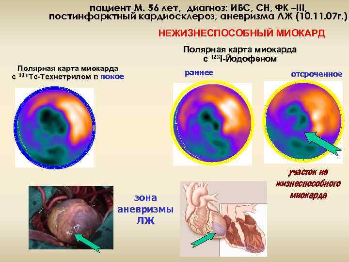 пациент М. 56 лет, диагноз: ИБС, СН, ФК –III, постинфарктный кардиосклероз, аневризма ЛЖ (10.