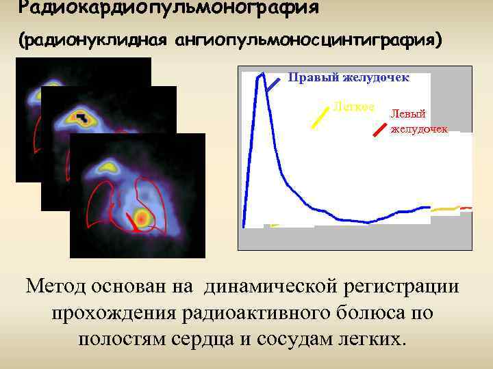 Радиокардиопульмонография (радионуклидная ангиопульмоносцинтиграфия) Правый желудочек Легкое Левый желудочек Метод основан на динамической регистрации прохождения