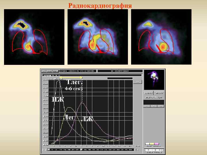 Радиокардиография Тлег. (4 -6 сек) ПЖ Лег ЛЖ 