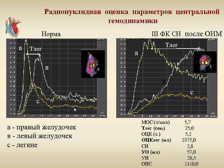 Радионуклидная оценка параметров центральной гемодинамики III ФК СН после ОИМ Норма а Тлег в