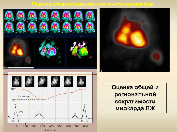 Радионуклидная равновесная вентрикулография Оценка общей и региональной сократимости миокарда ЛЖ 