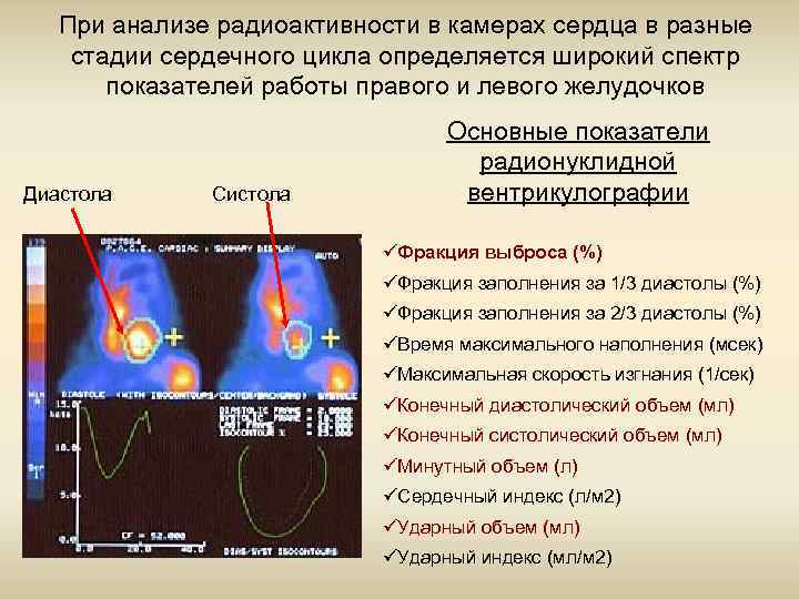 При анализе радиоактивности в камерах сердца в разные стадии сердечного цикла определяется широкий спектр