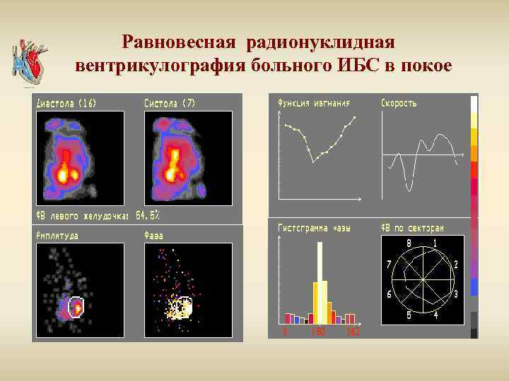 Равновесная радионуклидная вентрикулография больного ИБС в покое 