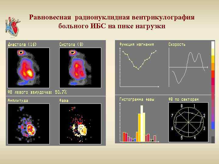 Равновесная радионуклидная вентрикулография больного ИБС на пике нагрузки 