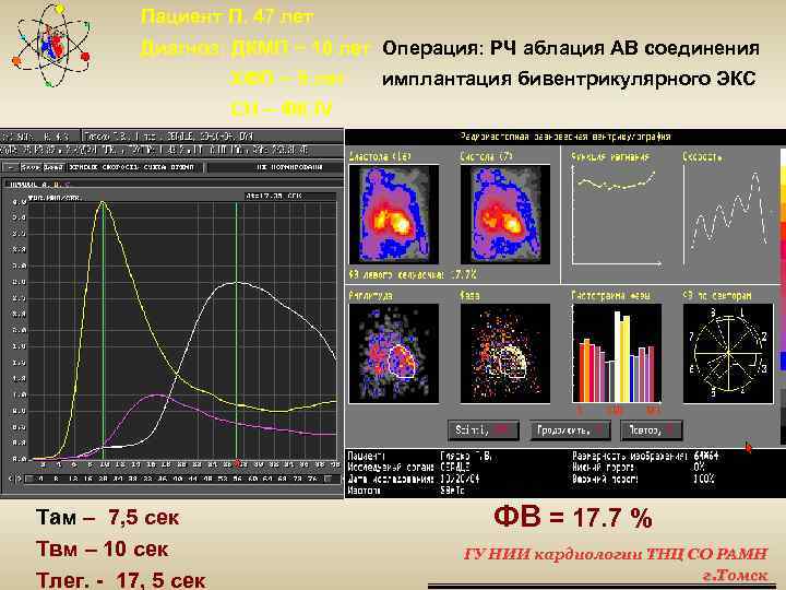 Пациент П. 47 лет Диагноз: ДКМП ~ 10 лет Операция: РЧ аблация АВ соединения