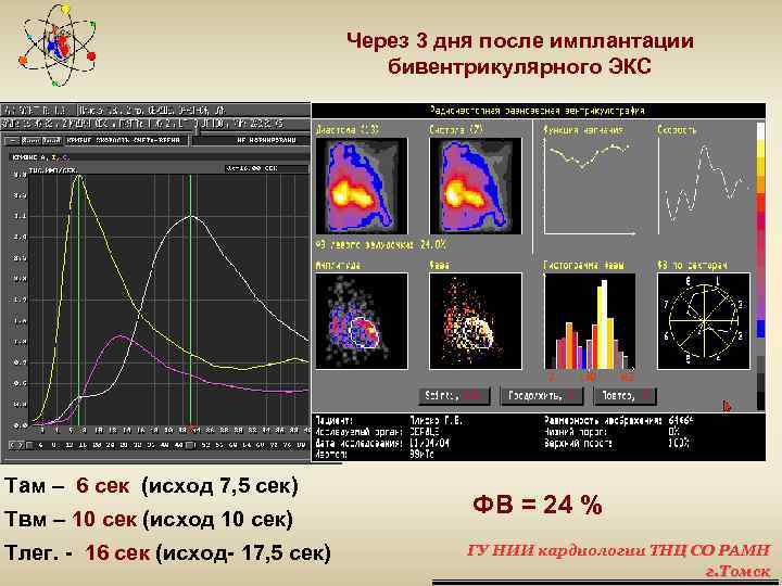 Через 3 дня после имплантации бивентрикулярного ЭКС Там – 6 сек (исход 7, 5