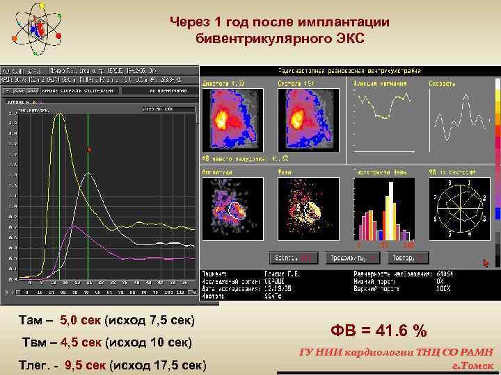 Через 1 год после имплантации бивентрикулярного ЭКС Там – 5, 0 сек (исход 7,