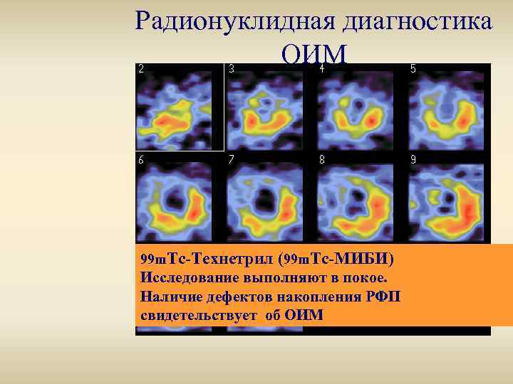 Радионуклидная диагностика ОИМ 99 m. Тс-Технетрил (99 m. Тс-МИБИ) Исследование выполняют в покое. Наличие