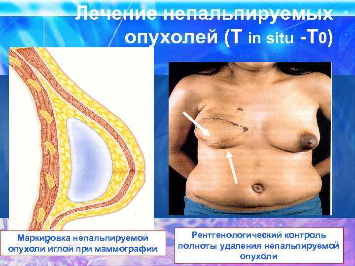 Лечение непальпируемых опухолей (T in situ -Т 0) Маркировка непальпируемой V опухоли иглой при