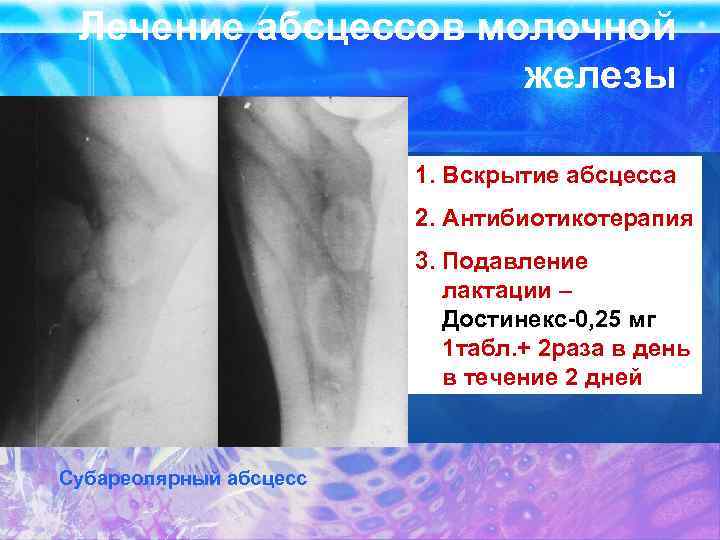 Лечение абсцессов молочной железы 1. Вскрытие абсцесса 2. Антибиотикотерапия 3. Подавление лактации – Достинекс-0,