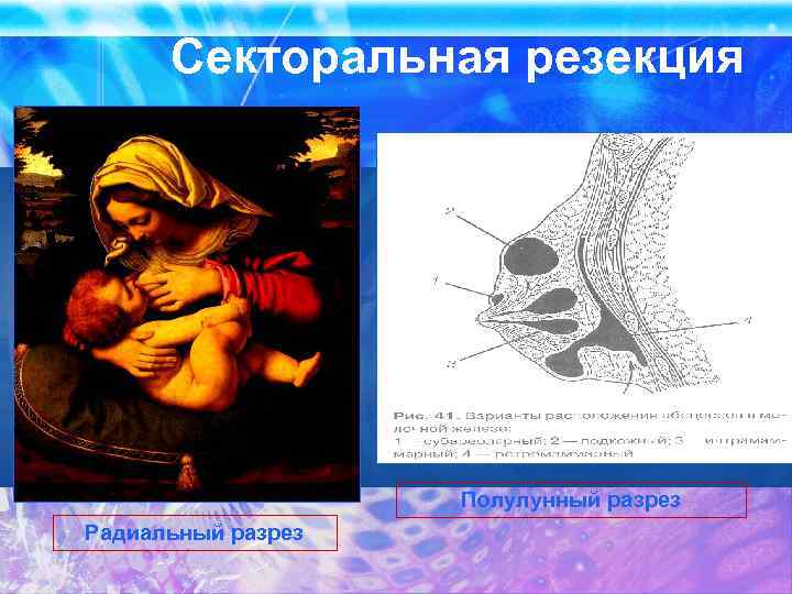 Секторальная резекция Полулунный разрез Радиальный разрез 