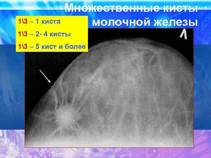 13 – 1 киста Множественные кисты молочной железы 13 – 2 - 4 кисты