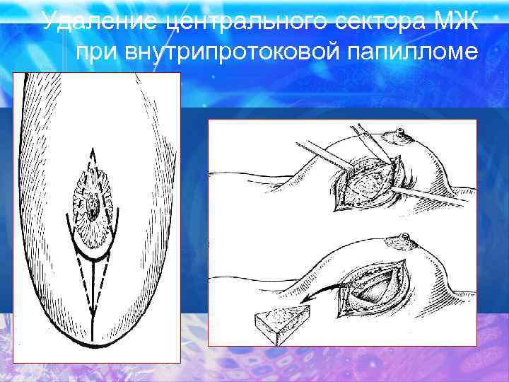 Удаление центрального сектора МЖ при внутрипротоковой папилломе 