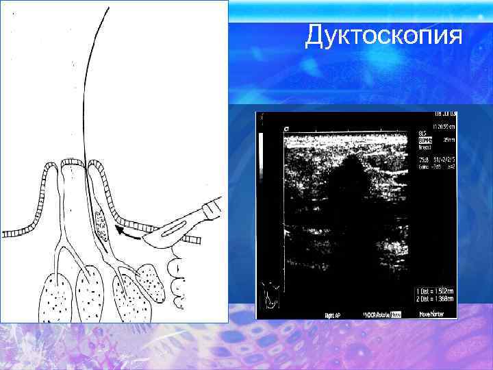 Дуктоскопия 