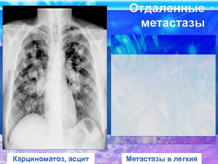 Отдаленные метастазы Карциноматоз, асцит Метастазы в легкие 