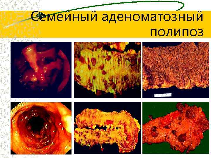 Семейный аденоматозный полипоз 