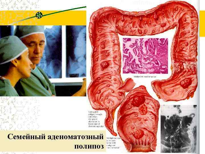 Семейный аденоматозный полипоз 