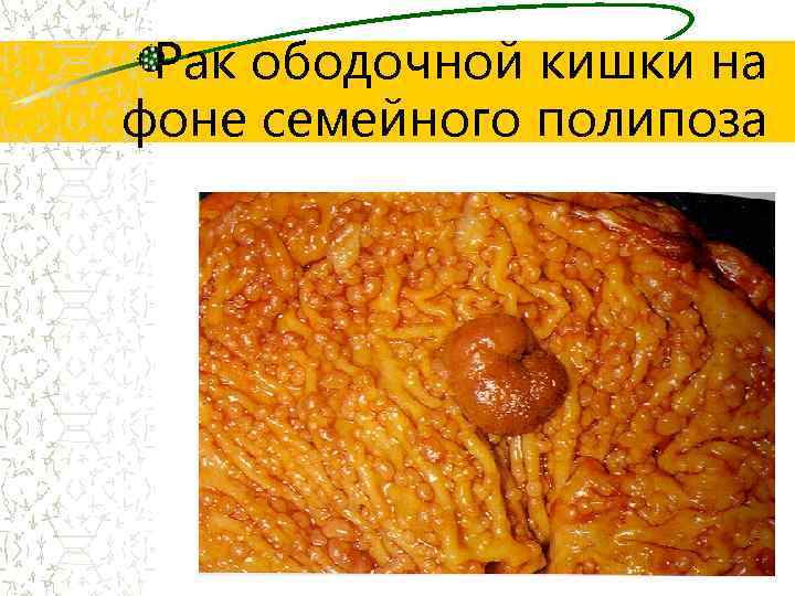 Рак ободочной кишки на фоне семейного полипоза 