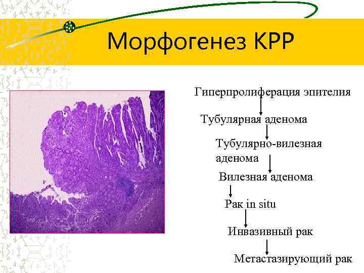 Морфогенез КРР Гиперпролиферация эпителия Тубулярная аденома Тубулярно-вилезная аденома Вилезная аденома Рак in situ Инвазивный