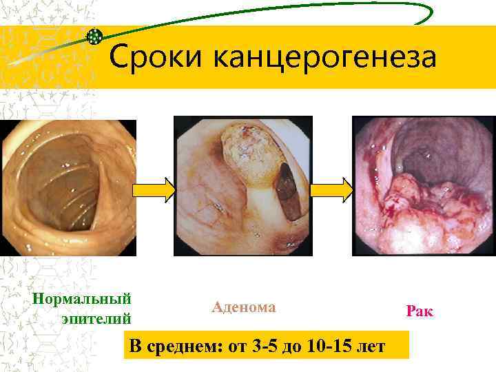 Сроки канцерогенеза Нормальный эпителий Аденома В среднем: от 3 -5 до 10 -15 лет