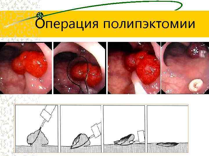 Операция полипэктомии 