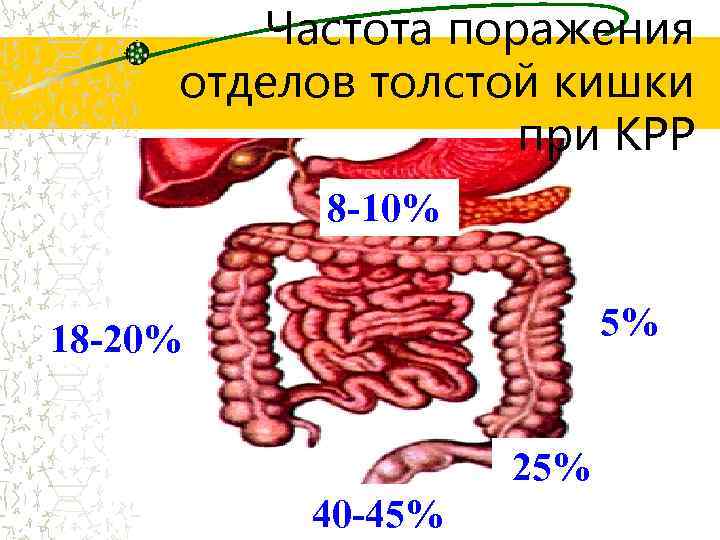 Частота поражения отделов толстой кишки при КРР 8 -10% 5% 18 -20% 25% 40
