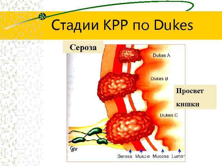 Стадии КРР по Dukes Сероза Просвет кишки 