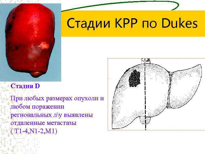 Стадии КРР по Dukes Стадия D При любых размерах опухоли и любом поражении региональных