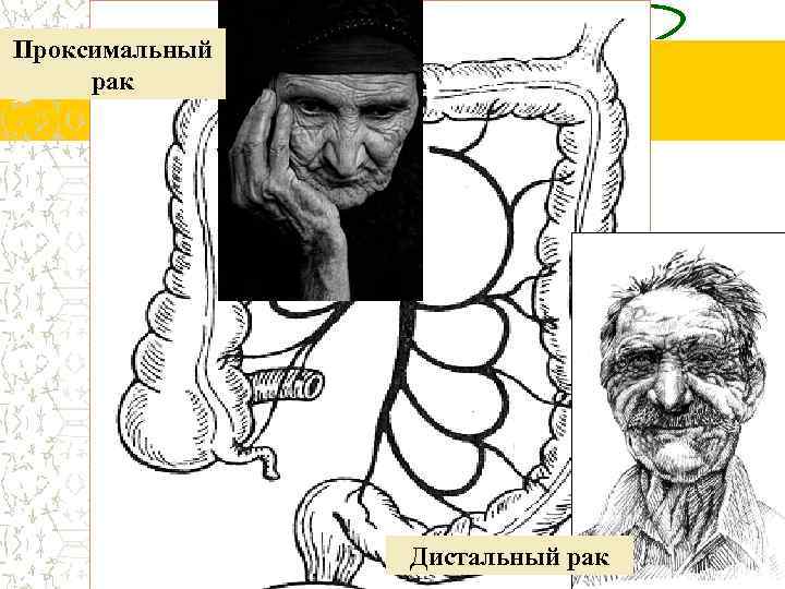 Проксимальный рак Дистальный рак 