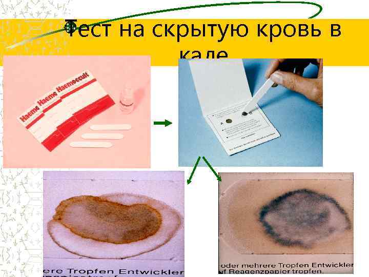 Тест на скрытую кровь в кале 